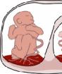 Feto-fetal transfusion syndrome (TTTS: twin-to-twin transfusion syndrome) Natural history of feto-fetal transfusion syndrome