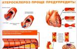 Развитие атеросклероза сосудов головного мозга у пожилых: симптомы и лечение Факторы и группы риска