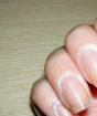 Nokti na prstima: uzroci, liječenje, prevencija Zašto se nokti stvaraju na prstima